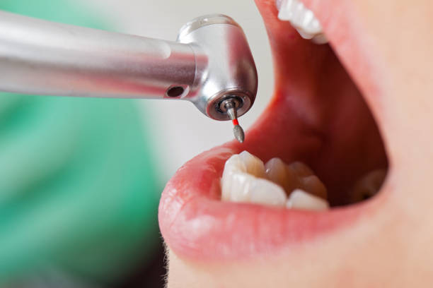 Best Emergency Treatment for Toothache in Opelousas, LA